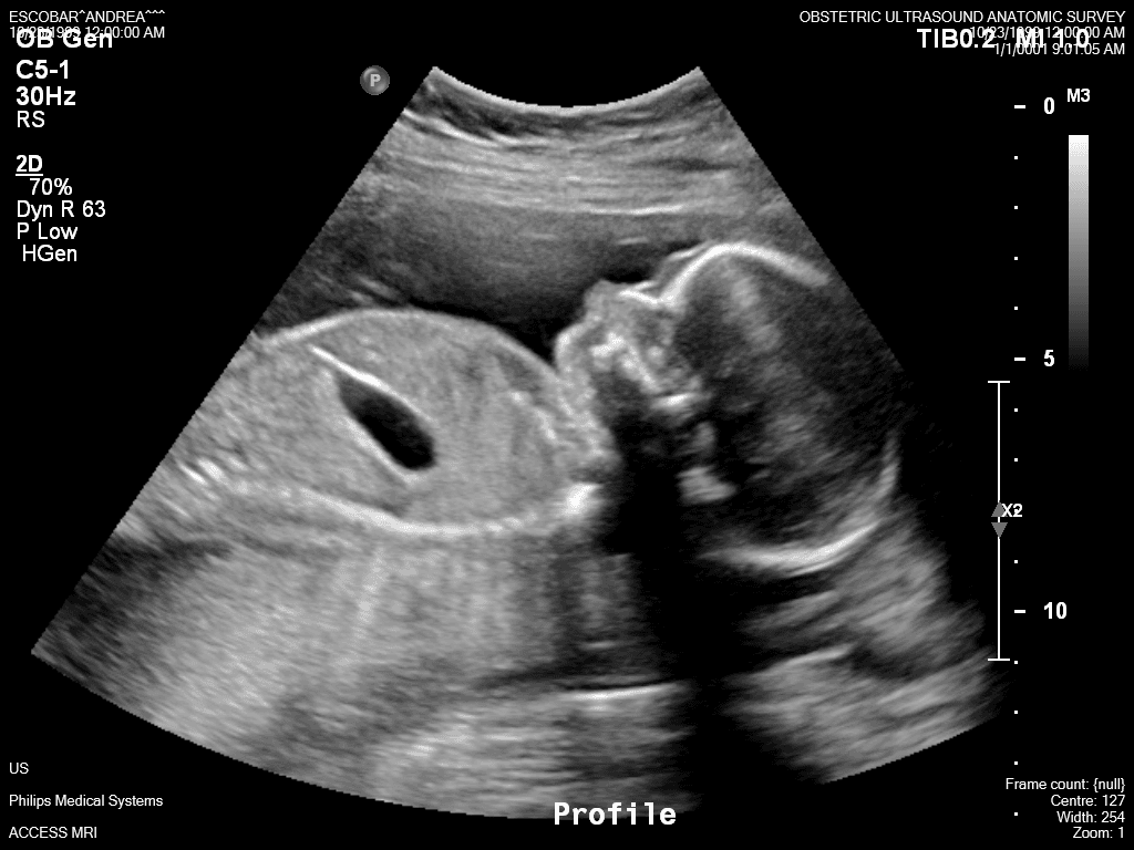 Baby Silva Ultrasound